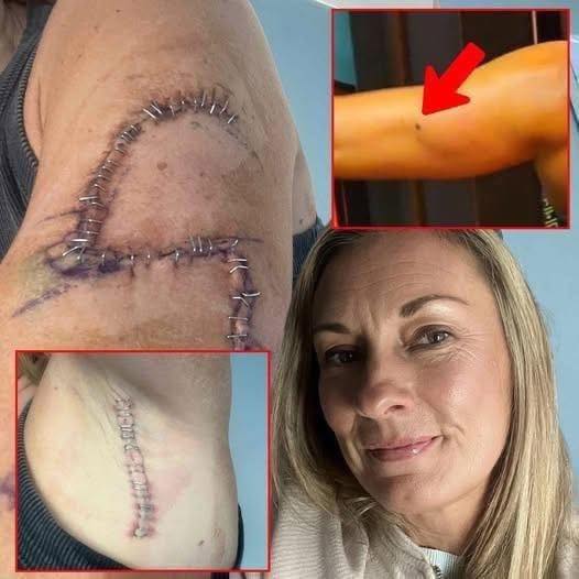 TG She Thought It Was Just A Mole… 77 Stitches Later, Doctors Told Her The Truth…