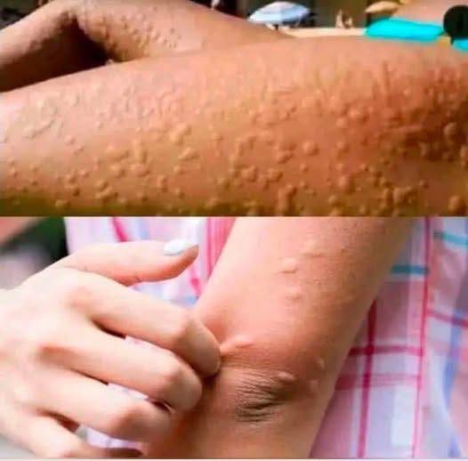 His entire body was itchy, he thought it was an allergy, and he was diagnosed.