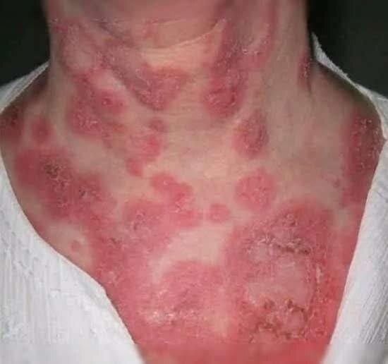 The Hidden Reasons You Keep Getting Pimples on Your Chin