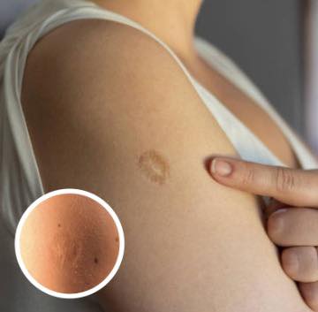 Here’s The Truth Behind This Scar On People’s Upper Left Arm