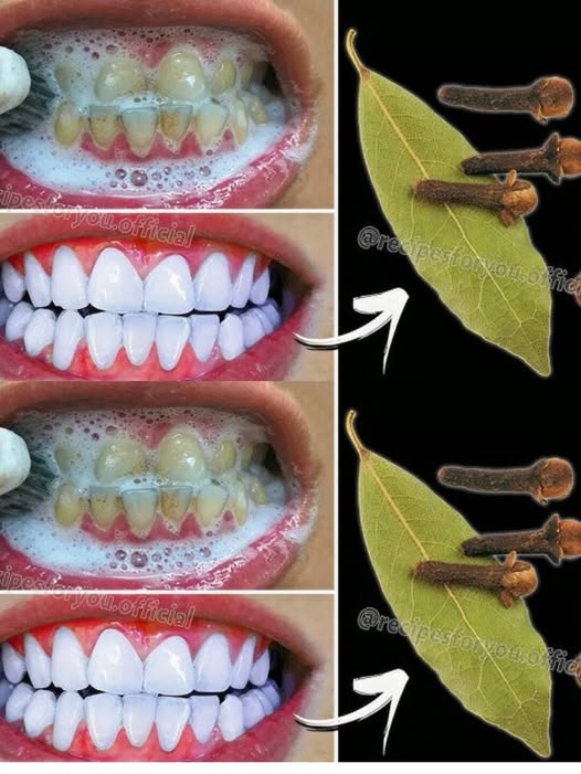 How Brightening Teeth with Bay Leaves Can Help Say Goodbye to Yellow Teeth – A Natural Remedy or Myth?