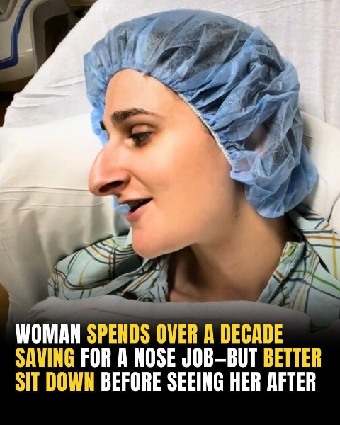 After more than ten years of saving for nose surgery, you will be stunned by the results!