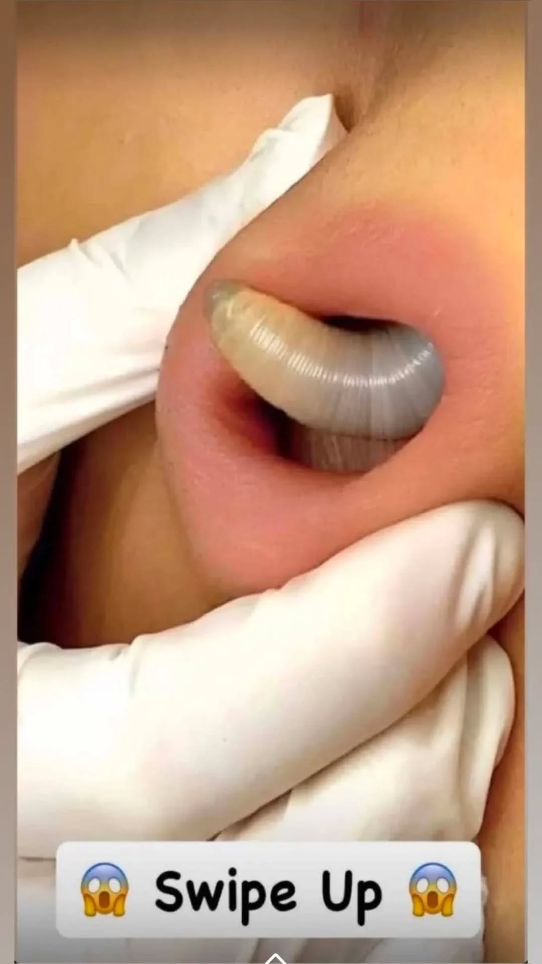 When Nature Meets Medicine: Understanding Leeches, Skin Attachment, and What It Means for Human Health