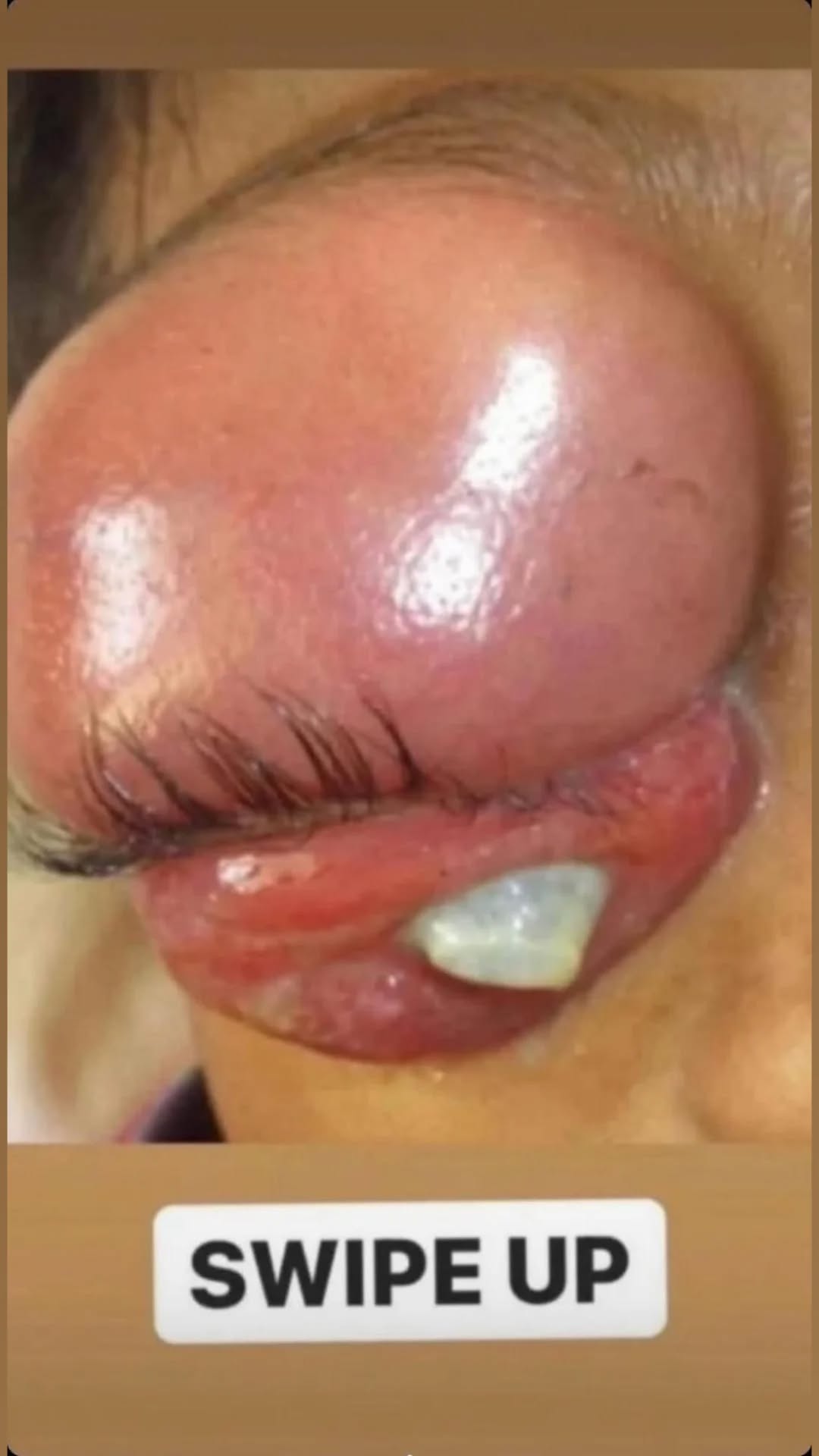 Understanding Severe Eyelid Swelling: Causes, Symptoms, and When to Seek Medical Care