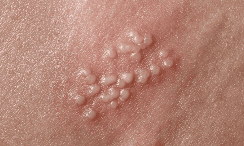 Genital Skin Changes: When to Worry and When to Relax