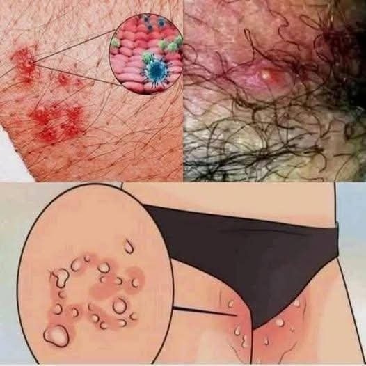 Groin Skin Problems Explained: Irritation, Rashes, and Prevention