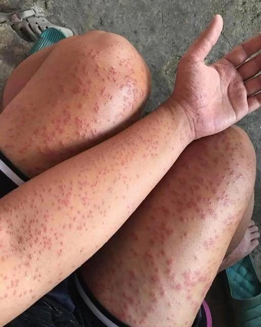 HT15. I Slept at my friends old apartment for a couple days noticed these weird bump…See more