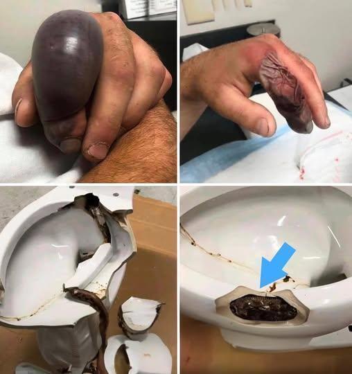 Snake Bites from Toilets: How Rare Incidents Highlight an Unusual Safety Risk