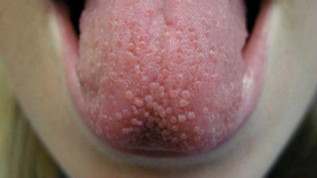 Understanding Bumps on the Tongue: Causes, Symptoms, and When to See a Doctor