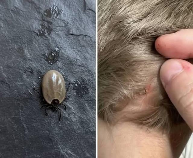 Ticks and Tick Bites Explained: What You Need to Know to Stay Safe