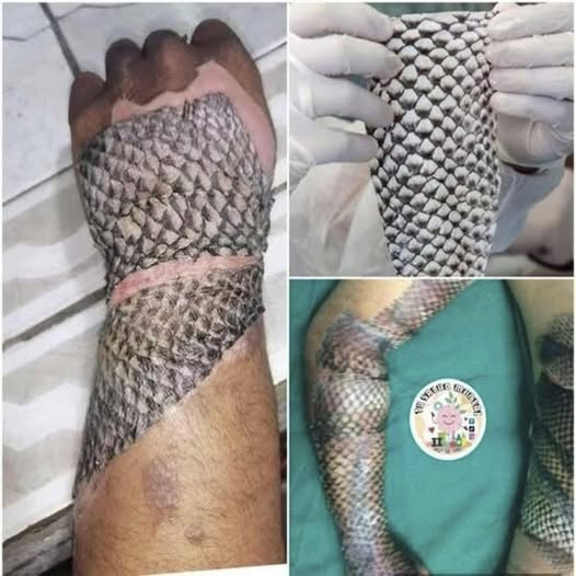 Natural Innovation in Medicine: Tilapia Skin Shows Promise in Modern Burn Care