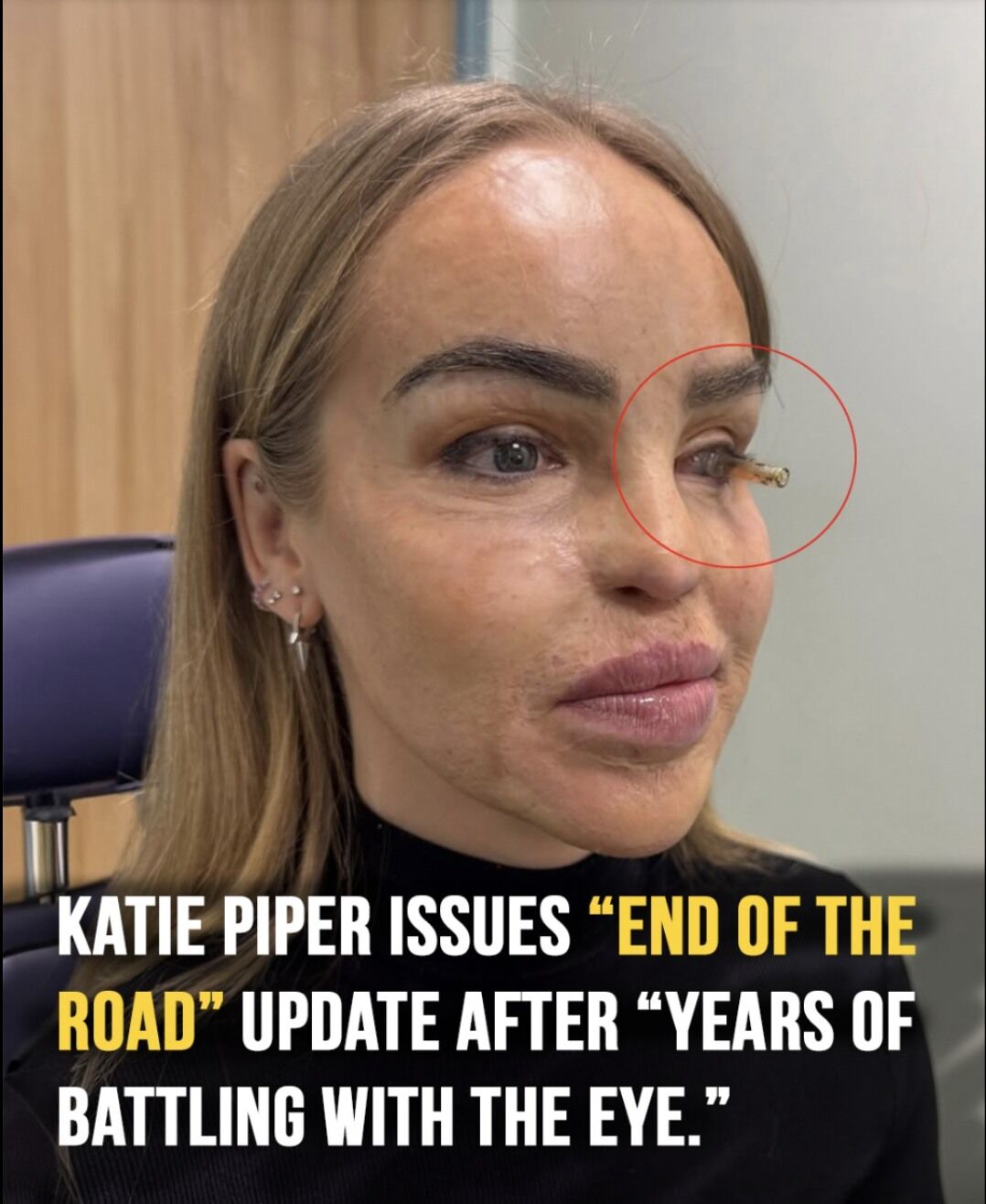 Katie Piper Begins New Chapter After Emotional Decision to Transition to Prosthetic Eye