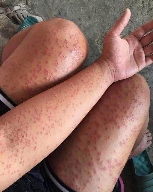 I Slept at My Friend’s Old Apartment—Then These Bumps Appeared